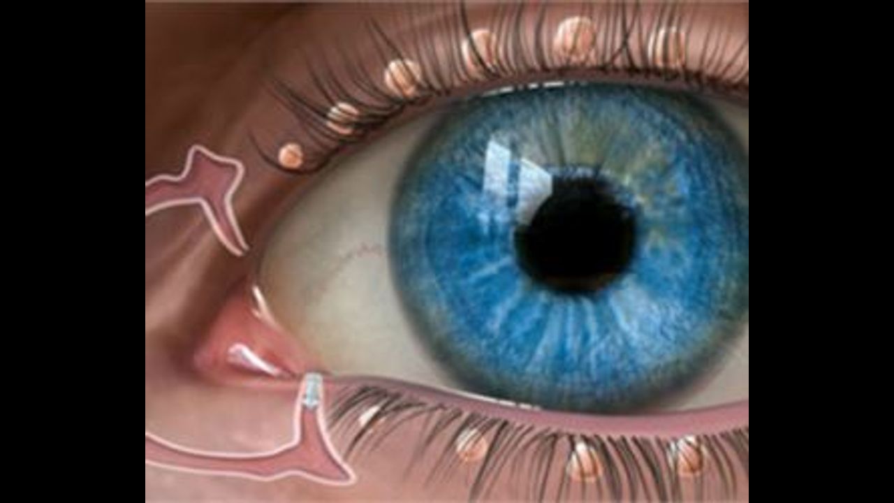 Из глаза выделяется белая тянущаяся. Отверстия на слизистой глаза